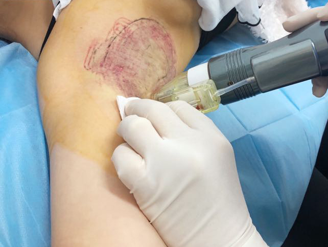 黄金微针治疗是运用黄金包裹的微针矩阵状排列刺入肌肤深层,在针尖处