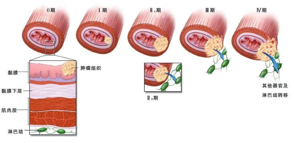 來自我國食管癌高發區(河北,河南,山西三省交界的太行山南側,在大別