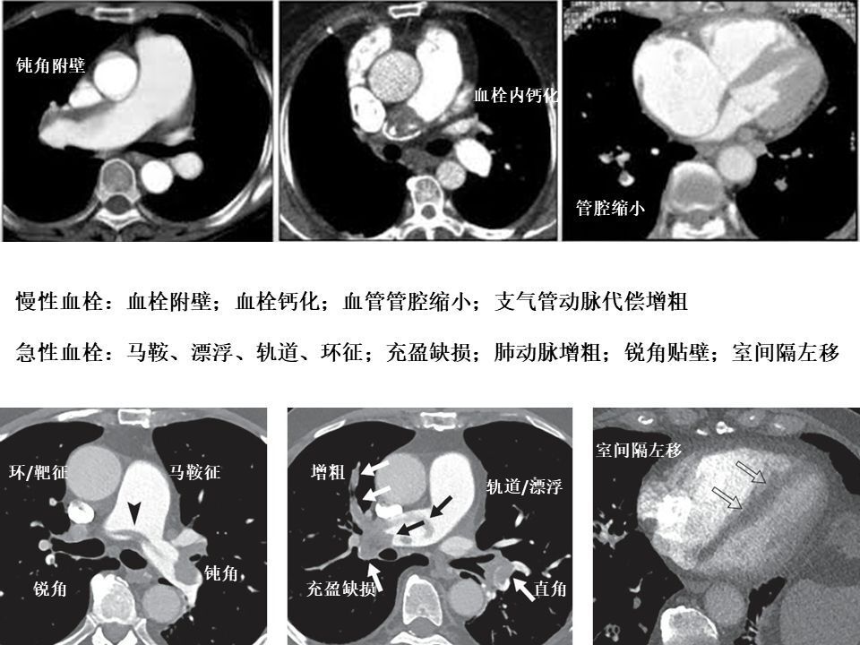 肺动脉 cta 不会看?这篇教你轻松诊断肺栓塞!