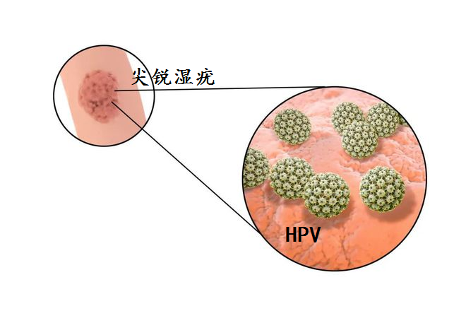 鄭州合心醫院:感染了hpv就一定會得尖銳溼疣嗎?_騰訊新聞