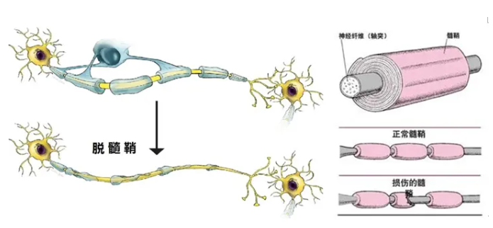西安市红会医院神经内科成为陕西神经系统炎性脱髓鞘病联盟成员单位