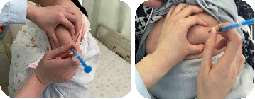 打肝素怎么拔针低分子肝素应该怎样注射？一文详细总结！_https://www.jmylbn.com_新闻资讯_第5张