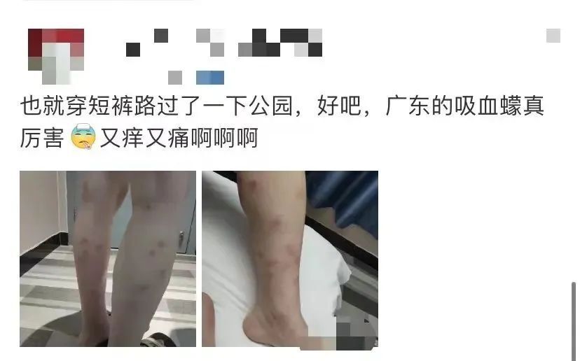不能到医院就诊的,可用冰敷或涂抹炉甘石的方法缓解,切勿用人