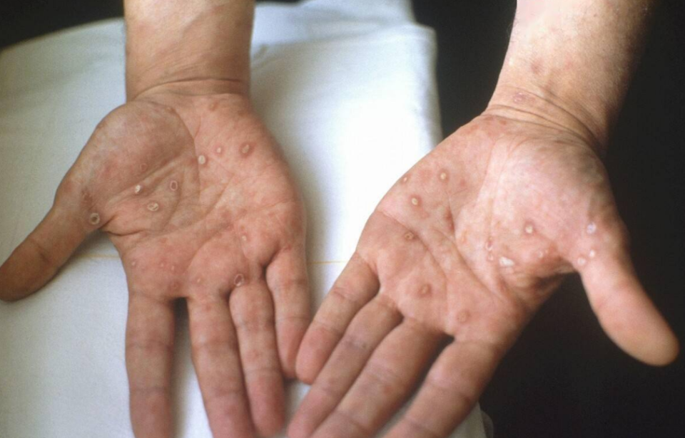 若梅毒"潜藏"在体内,身体可能会发出4个"预警信号",别大意