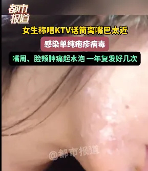 KTV话筒竟藏如此风险！你还敢毫无防备地唱歌吗？