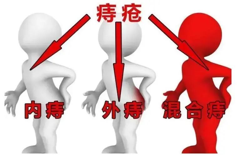 但有的人痔疮症状明显,有的痔疮患者却毫无感觉.