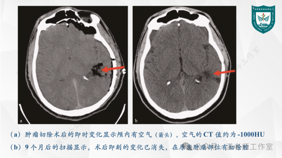 脑ct图图片