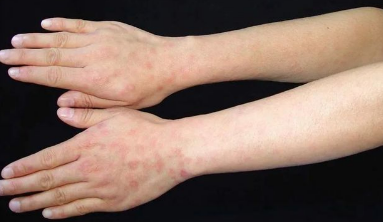 若梅毒"潜藏"在体内,身体可能会发出4个"预警信号",别大意_腾讯新闻