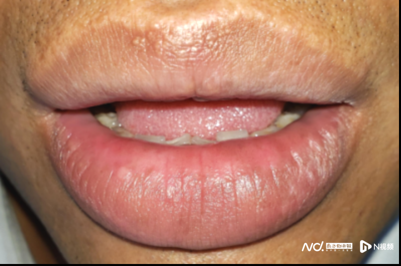 知名歌手因黑色素瘤去世!口腔黏膜长黑斑要小心癌变