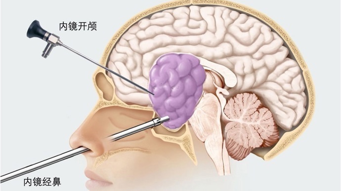 经鼻蝶垂体瘤手术步骤图片