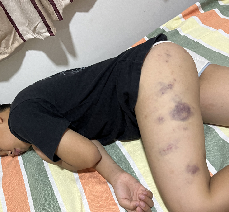 青岛10岁男童遭托管班教师殴打身体大片淤青涉事老师被行拘教体局回应