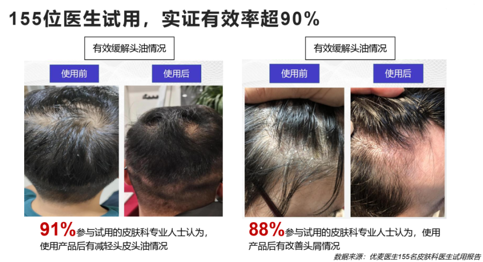 头皮屑真不是脏!别再说人家好脏了!