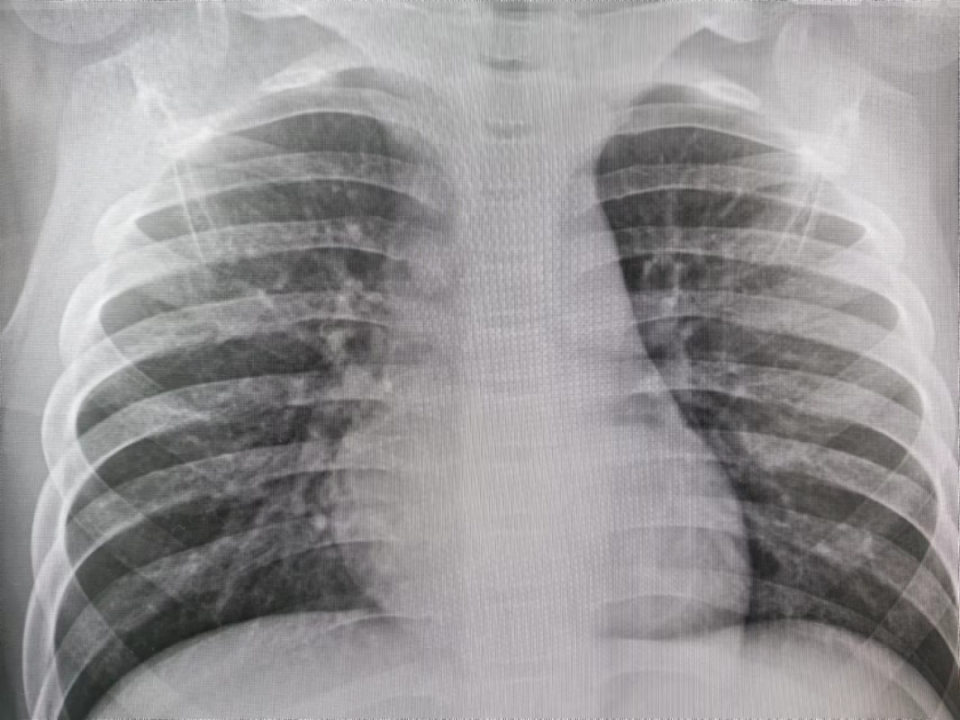 虽然咳嗽不严重,但医生也担心有肺炎可能,就给小明做了胸片检查,结果