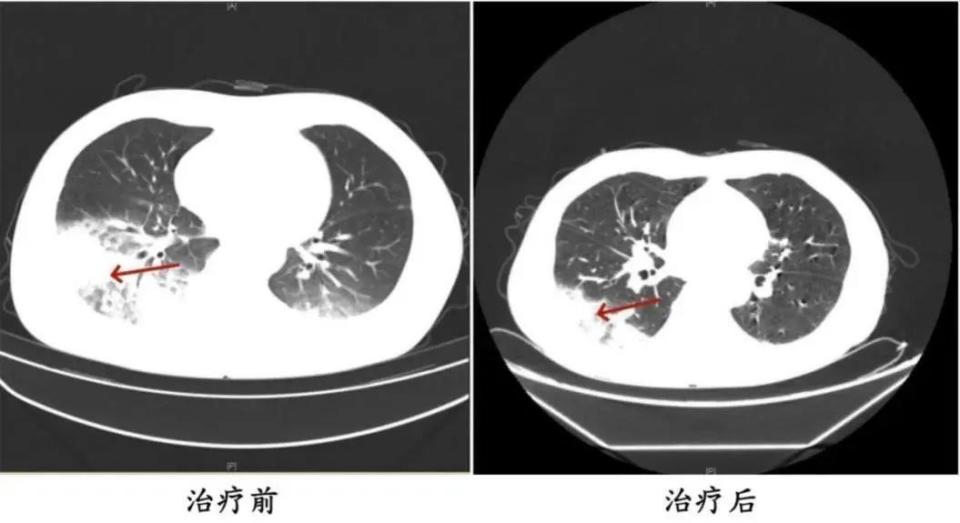 气温升高吹空调竟吹出肺炎？久未清洗的空调有多可怕