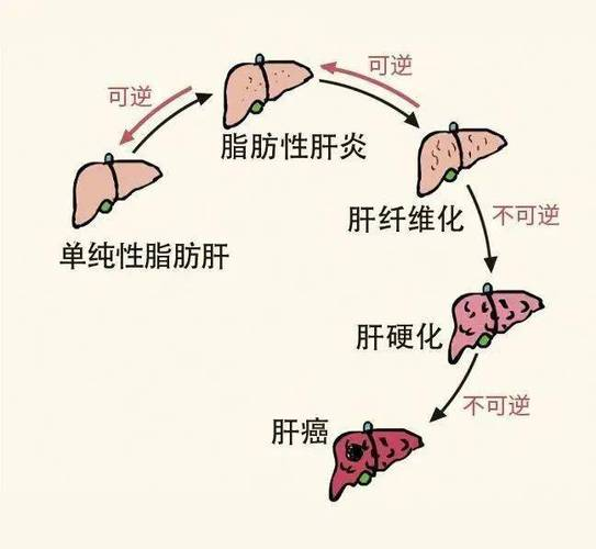 大众健康丨 "沉默的杀手"——脂肪肝