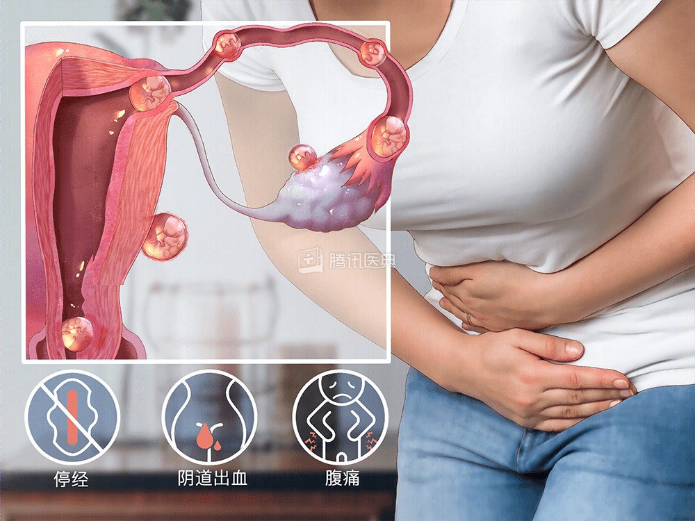 月经没来小肚子却痛,要小心这4种"急腹症"