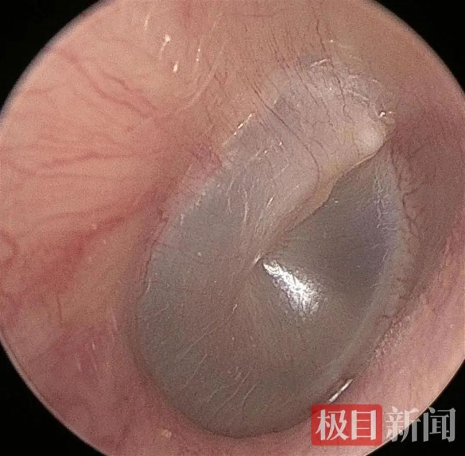 男子长期和宠物猫一起睡觉,医生从他的耳道里取出了活体猫螨虫