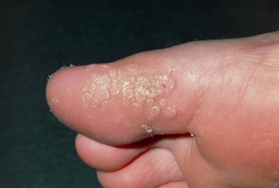 酒店光脚洗澡竟感染HPV？跖疣的真相你知道多少