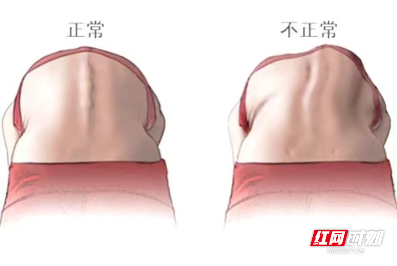 高低肩?小心是脊柱侧弯!趁着暑假让孩子体态值