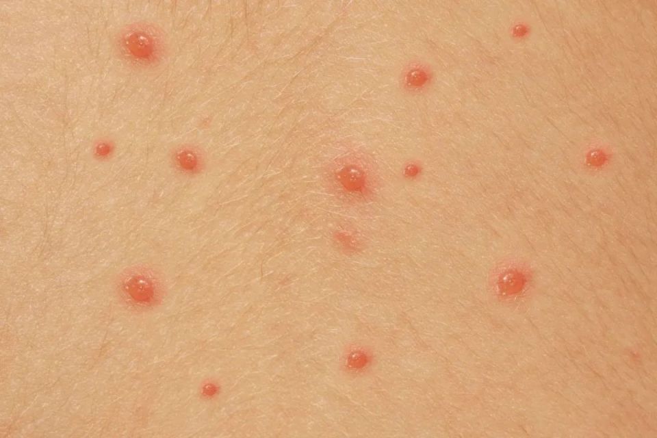 这种小疙瘩千万别揪!当心是"疣"!没有性生活也会感染hpv.