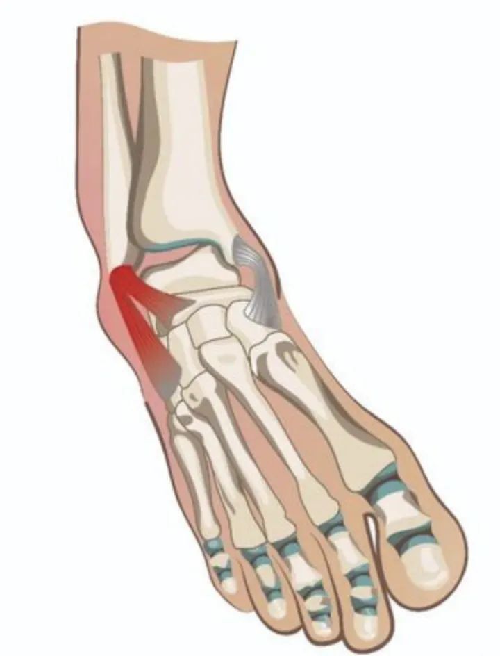 小运动员崴脚了,严重吗?