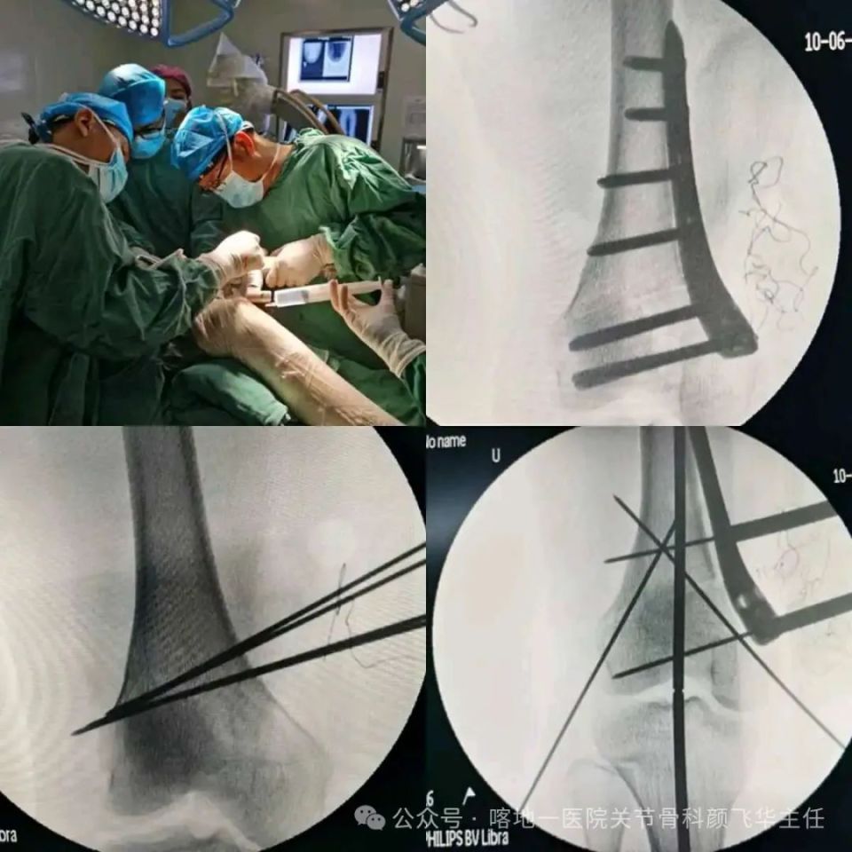 喀地一院"【颜医生说科普】系列6||膝关节周围截骨治疗膝关节炎饰问