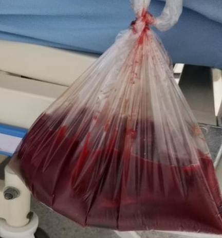 福州一男子5分钟口吐上千毫升鲜血致休克.