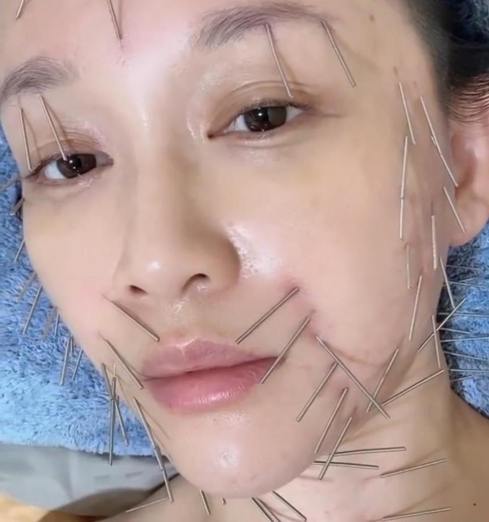 针灸美容走红，被称中式超声炮！真能让人颜