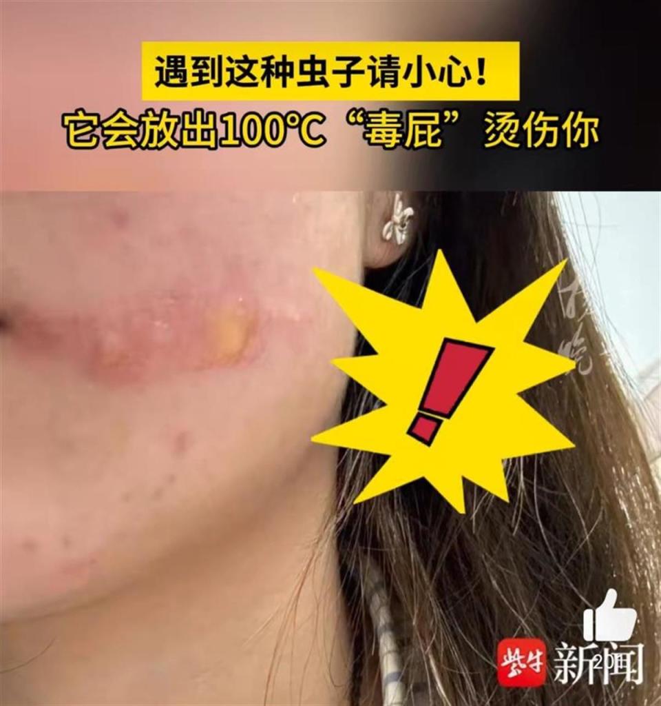 放屁虫的毒屁高达100女子脸上被烫出大水泡但它其实是益虫