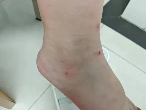 不能到医院就诊的,可用冰敷或涂抹炉甘石的方法缓解,切勿用人