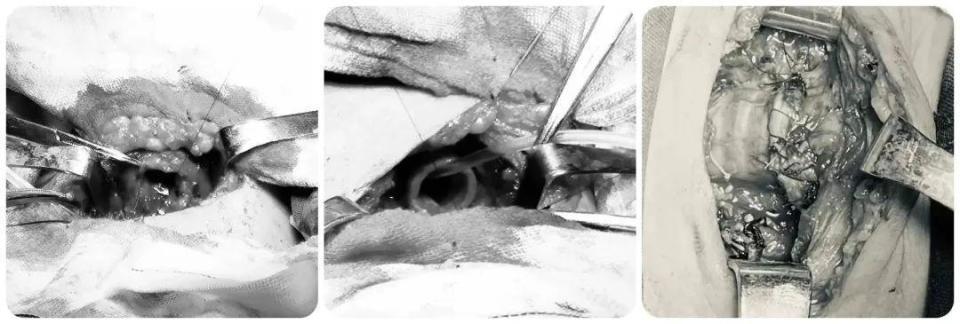 惠州一医院完成首例高难度气管肿瘤切除术