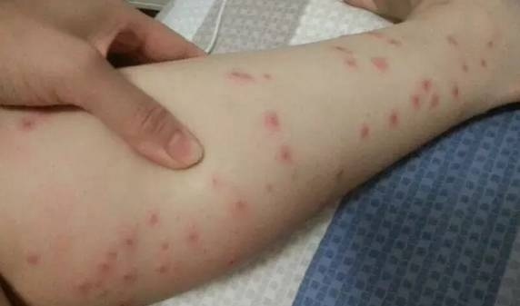 把你咬出一堆包的,真不一定是蚊子