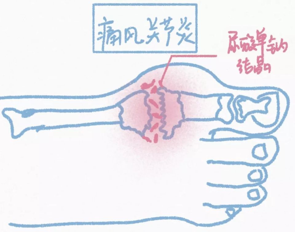 【科普营养】 痛风不止是吃出来的,还是喝出来的!