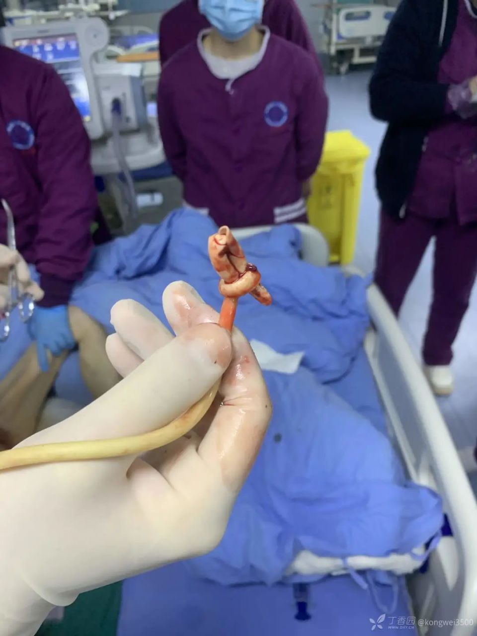 简要病史:患者留置导尿管后在拔除导尿管时遇阻,起初超声下看见球囊