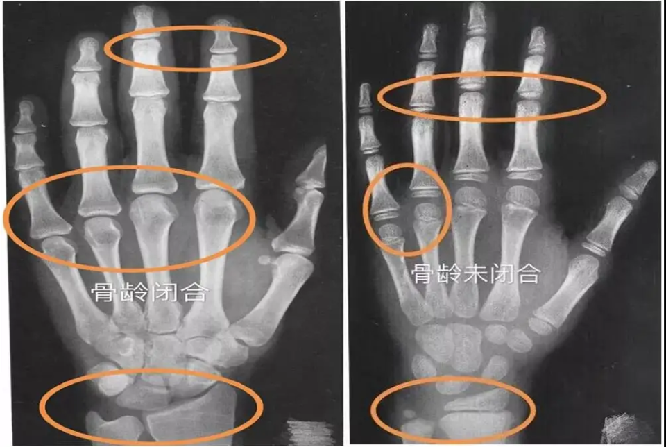 医生会根据x光片中的手掌指骨,腕骨及桡尺骨下端的骨化中心的发育程度