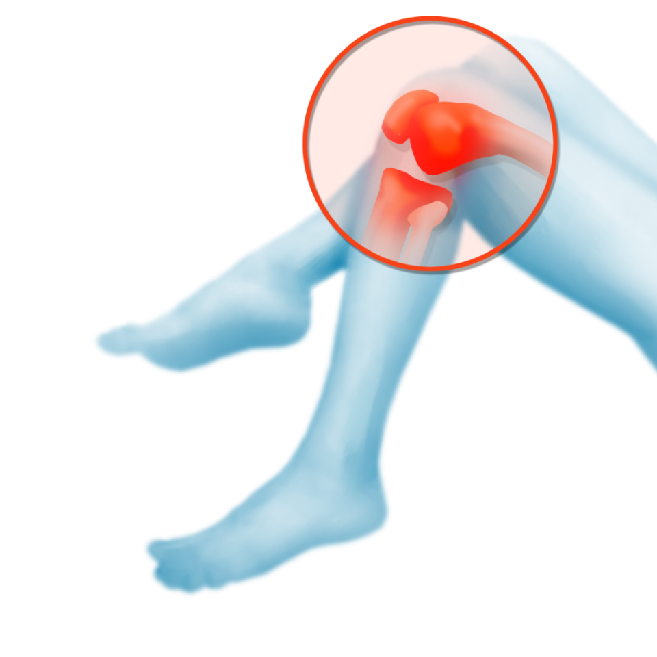 髌骨沿着髁间沟向下滑动膝关节屈曲时髌骨