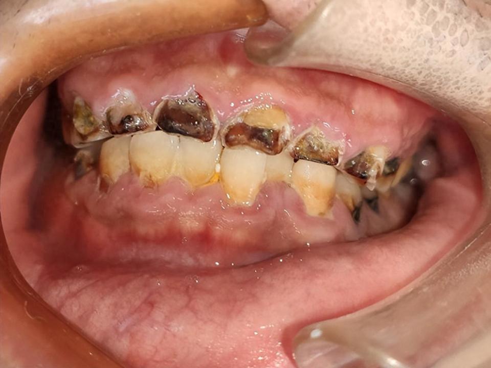 后果很严重!每天2瓶碳酸饮料,男子牙齿竟被"腐蚀"了!