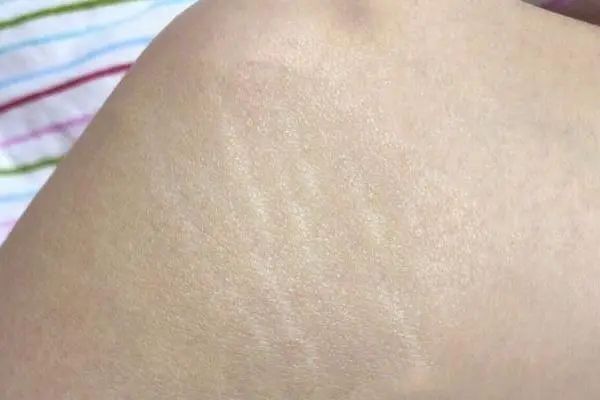 为什么别人的肥胖纹是红色我的是白色?