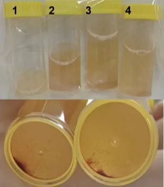 田欣伦教授:如何从"支气管肺泡灌洗液"细胞分类认识,甄别不同类型肺炎