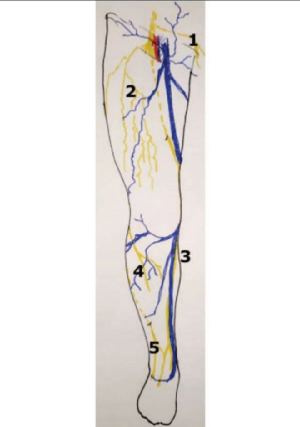 4) 外侧皮神经(腓总神经)在解决侧方静脉