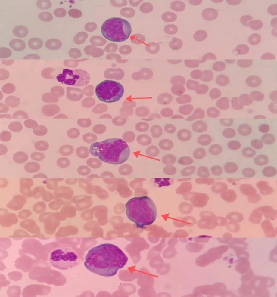 外周血涂片染色图片
