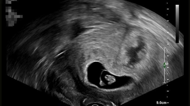 34岁孕妇多胎妊娠上演"宫心计",体内"宫斗"险致三败俱伤