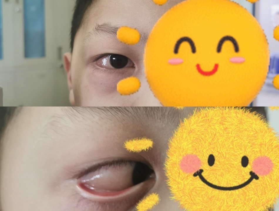 被剥过鸡蛋的手碰了下,6岁男童患上过敏性结膜炎