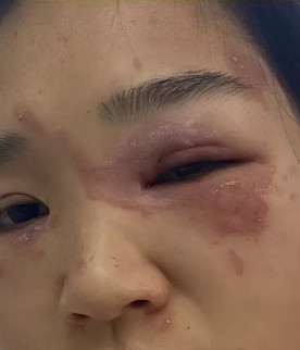 警惕!即将进入活跃期,不少人中招:眼皮肿了,脖子都烂了