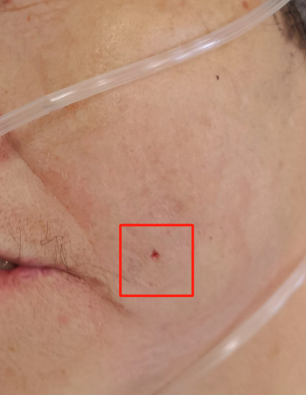 终于能好好洗把脸了"70岁大爷被三叉神经痛折腾了2年!