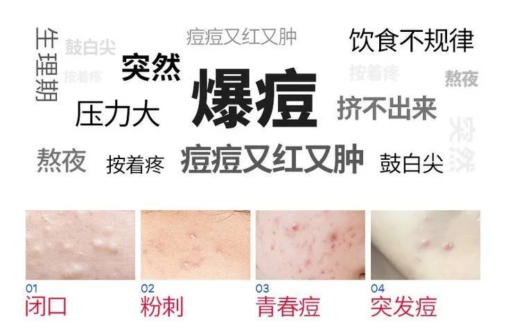 有一种绝望,叫30岁了还长痘痘