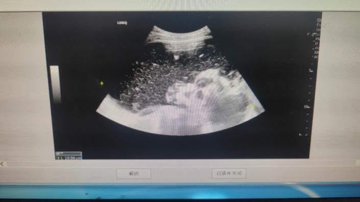 行b超检查显示右侧附件区见19.9×17.4×10