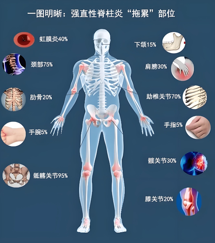 强直性脊柱炎会遗传吗图片