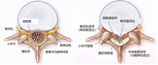 腰椎管狭窄图解图片