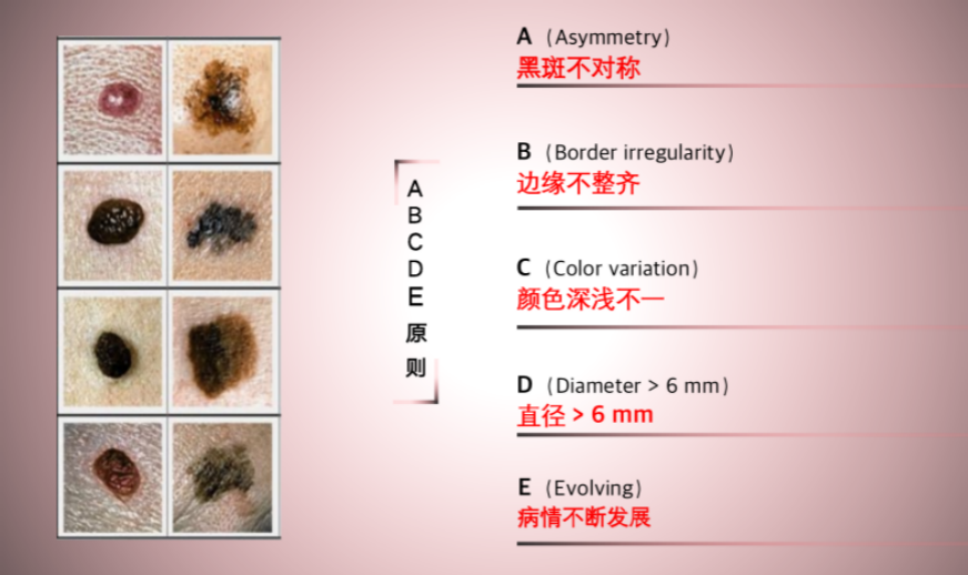 口腔粘膜黑痣是否危险图片